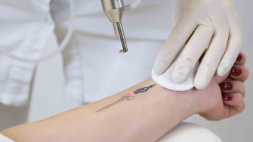 Robots Are Here to Take Your Tattoo Away