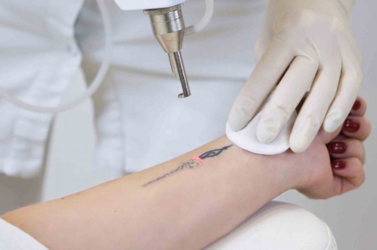 Robots Are Here to Take Your Tattoo Away